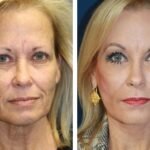 Deep Plane vs. Mac Lift: las diferencias entre las técnicas de lifting facial que buscan un rejuvenecimiento más natural